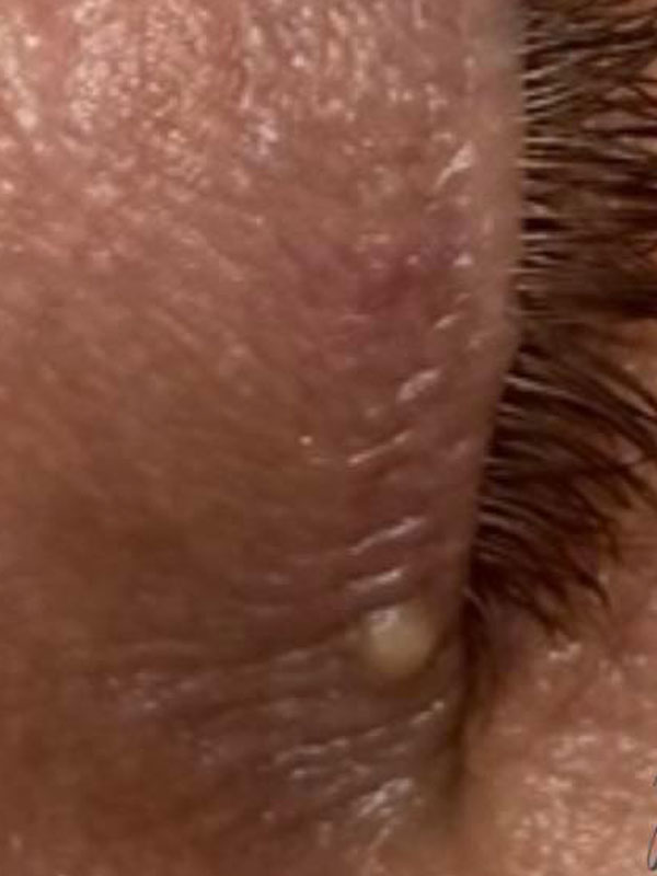 Basingstoke Clinic Skin Tag Removal