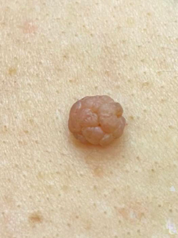 Skin Tag Removal Basingstoke Dermatology