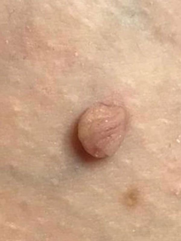 Private Skin Tag Removal Basingstoke